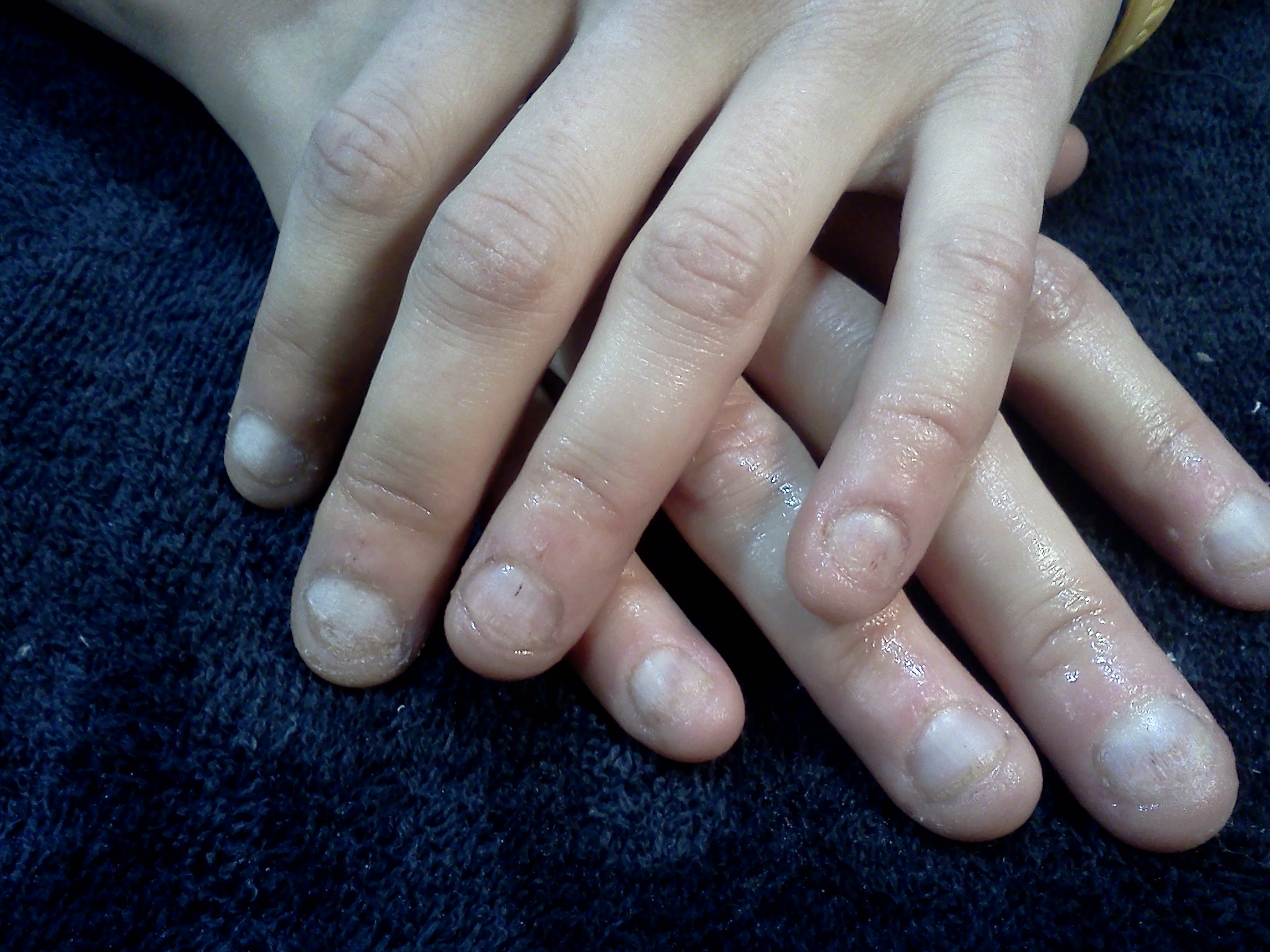 Paronychia - Skin Infection Around the Nails | familydoctor.org
